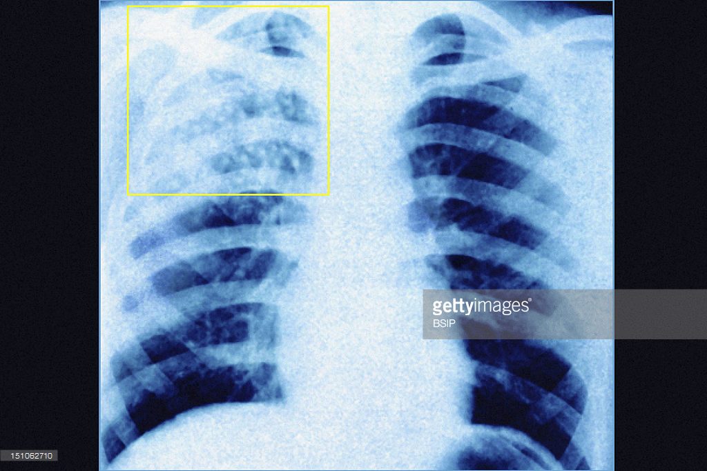 tuberculosis x-ray