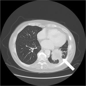 atypical-lung-cancer