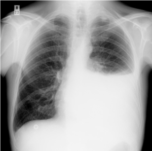 malignant-pleural-effusion-image